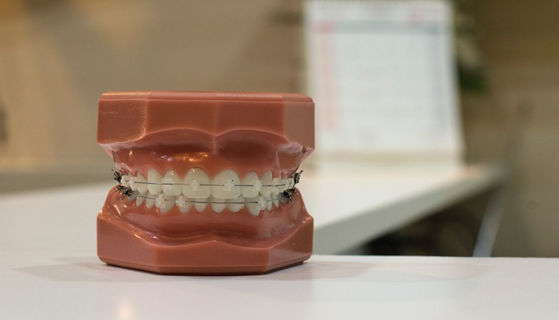 tooth brace at panoral dental clinics