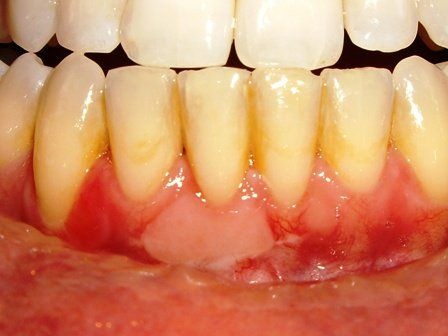 An image showing a teeth with Receding gum.